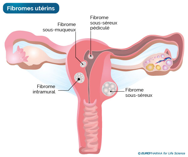 anatomie-fibromes