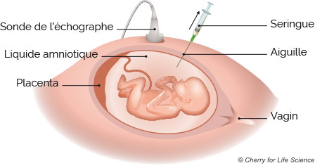 schéma amniocentese