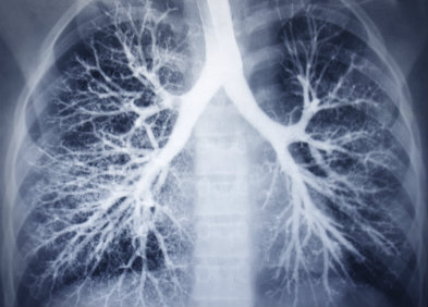 angiographie pulmonaire