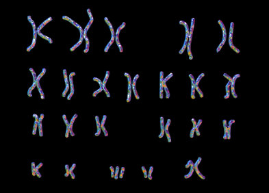 Trisomies 8, 13, 22, X, syndrome de Klinefelter & Jacob