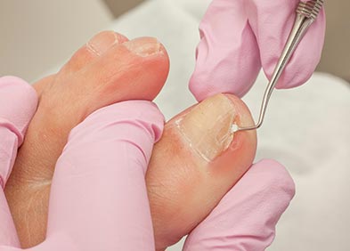 Ongle Incarne Reconnaitre Les Symptomes Et Traiter L Ongle Incarne