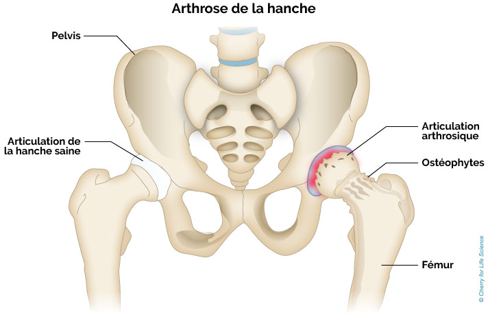 dureri in articulatia femurului - Durere la femur și inghinal
