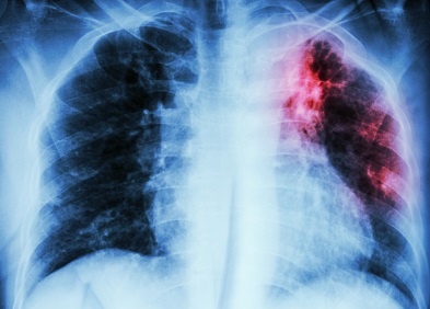 Fibrose pulmonaire idiopathique