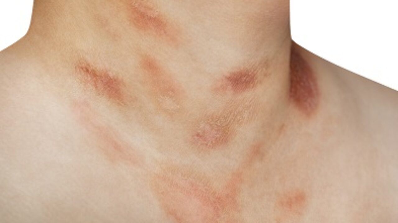 Pityriasis Versicolor Causes Symptomes Traitements Sante Sur Le Net Pityriasis Versicolor Causes Symptomes Traitements Sante Sur Le Net