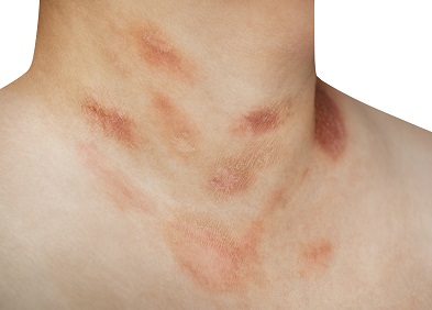 Pityriasis versicolor Causes, symptômes, traitements