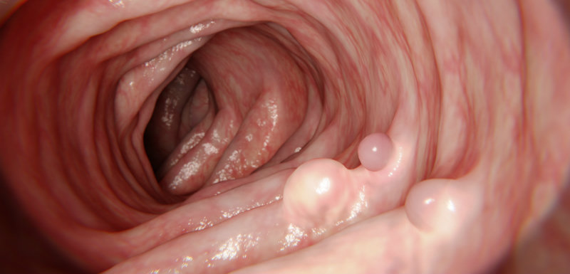 vue intérieure du côlon avec polypes dépistage du cancer colorectal