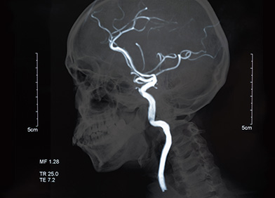 Rupture d’anévrisme : symptômes, diagnostic et traitement