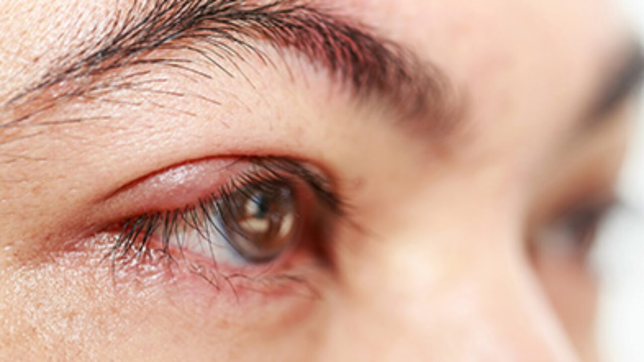 Chalazion Definition Symptomes Et Traitement De Cette Affection Oculaire