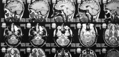 Maladies neurodégénératives : un grand pas vers la médecine personnalisée