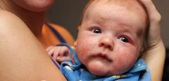 Que faire face à une allergie cutanée chez un nourrisson ?