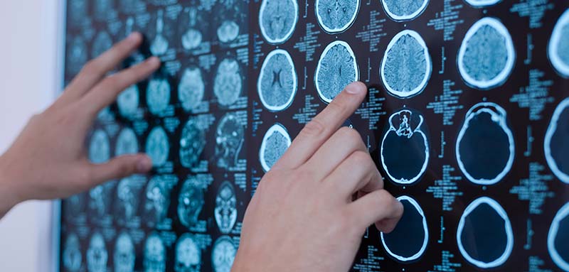 Cancer du cerveau : la piste prometteuse d'un vaccin personnalisé