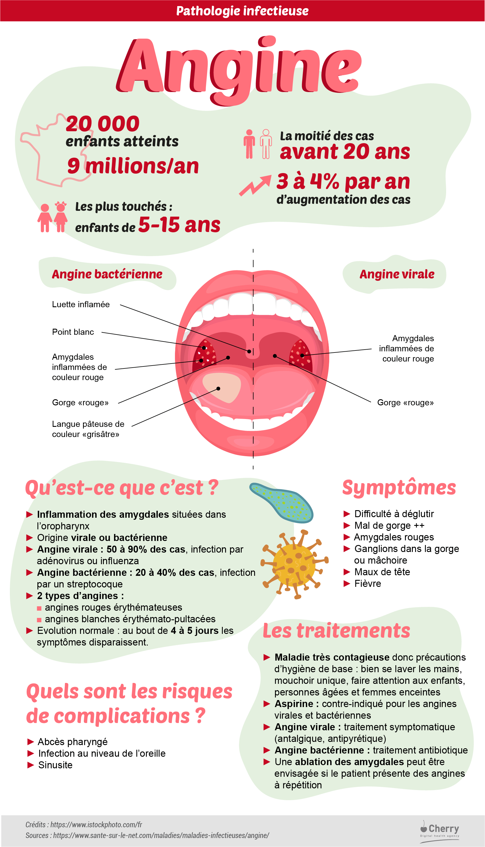 Angine : virale, bactérienne, symptômes, prévention, traitements