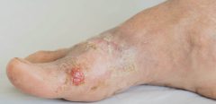L Impetigo Impetigo Crouteux Impetigo Bulleux Sante Sur Le Net L Impetigo Impetigo Crouteux Impetigo Bulleux Sante Sur Le Net