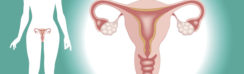 Kyste ovarien : définition, causes, symptômes, traitement