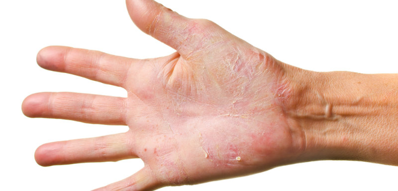 Eczéma des Mains : Causes, Symptômes & Traitement