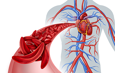 Blocage circulation sanguine par des cellules faucille dû à des cardiopathies congénitales