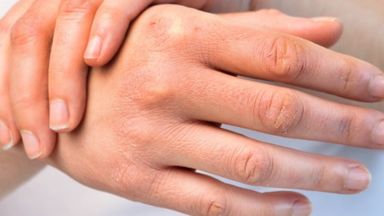 Dartre Definition Et Symptomes Sante Sur Le Net L Information Medicale Au Cœur De Votre Sante