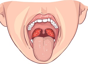 Amygdalite Définition Symptômes Et