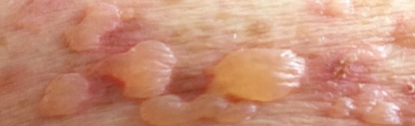 epidermolyse-bulleuse