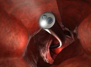 Diagnostic du cancer de l'intestin grêle : appareil médical qui rentre dans l'intestin pour contrôler
