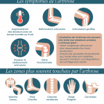 Infographie : L'arthrose en France