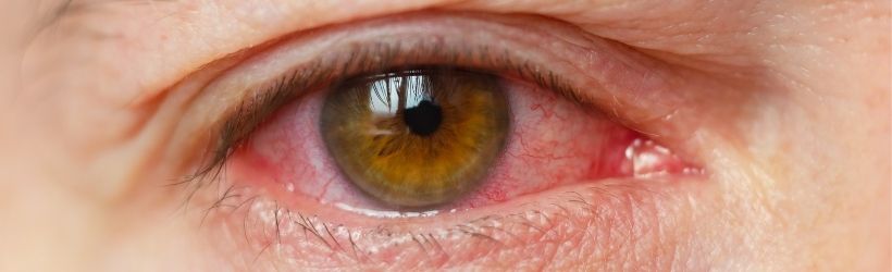oeil qui a une inflammation de la cornée