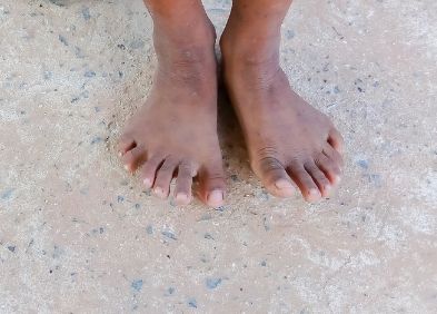 Polydactylie