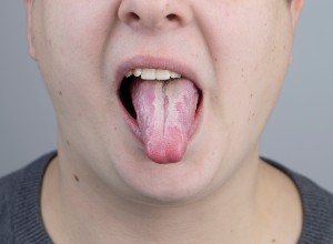 Homme avec des candidoses sur la langue
