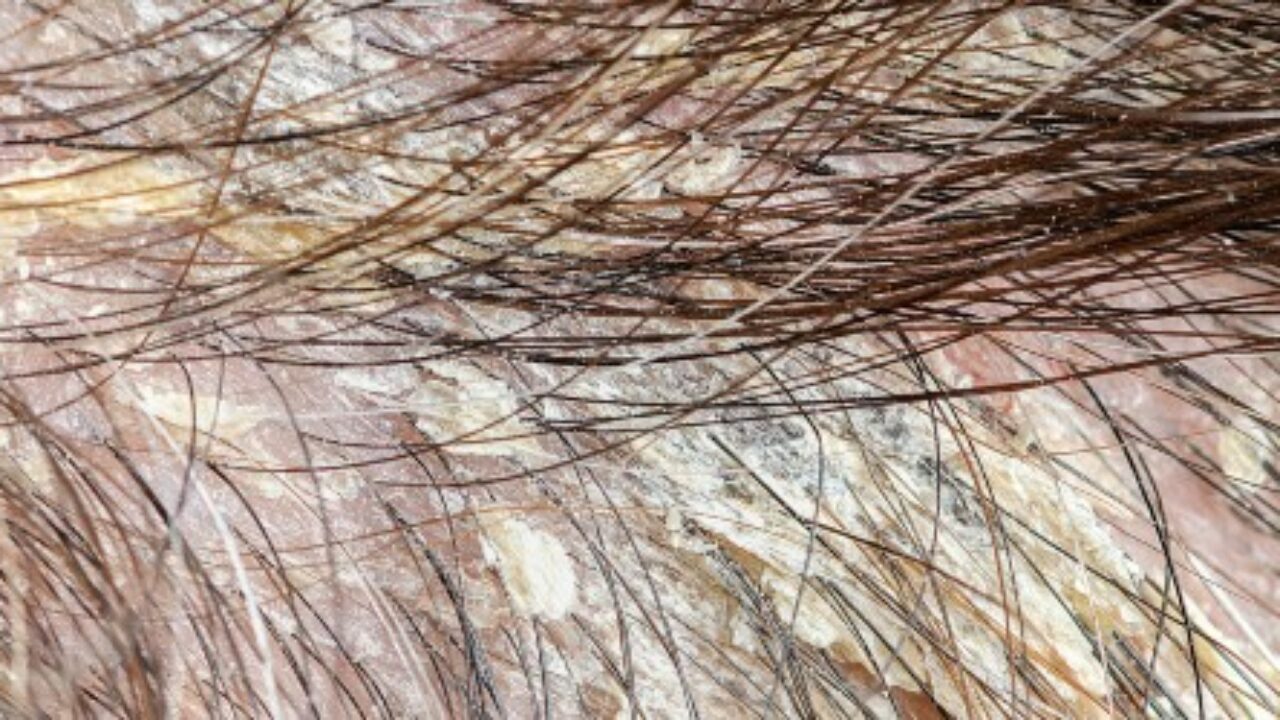 Dermite Seborrheique Definition Symptomes Diagnostic Et Traitements