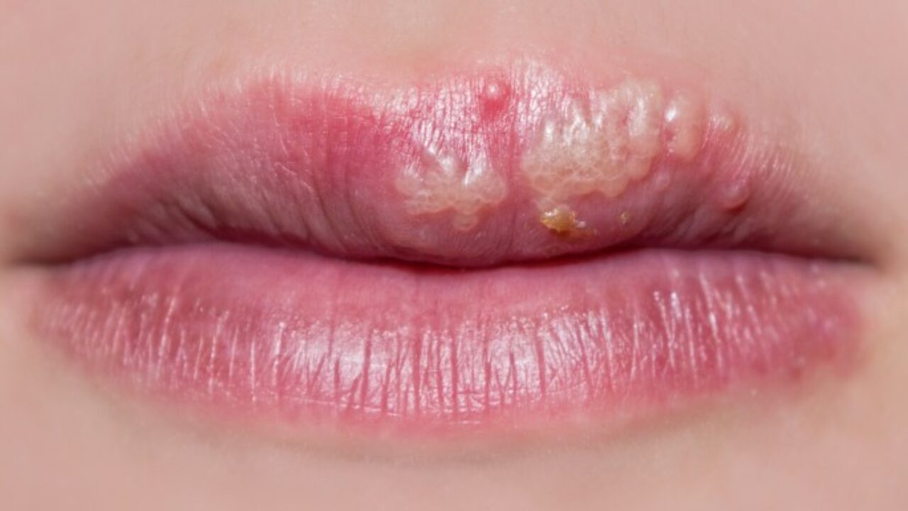 Tout Savoir Sur Les Boutons De Fievre Pour S En Debarrasser