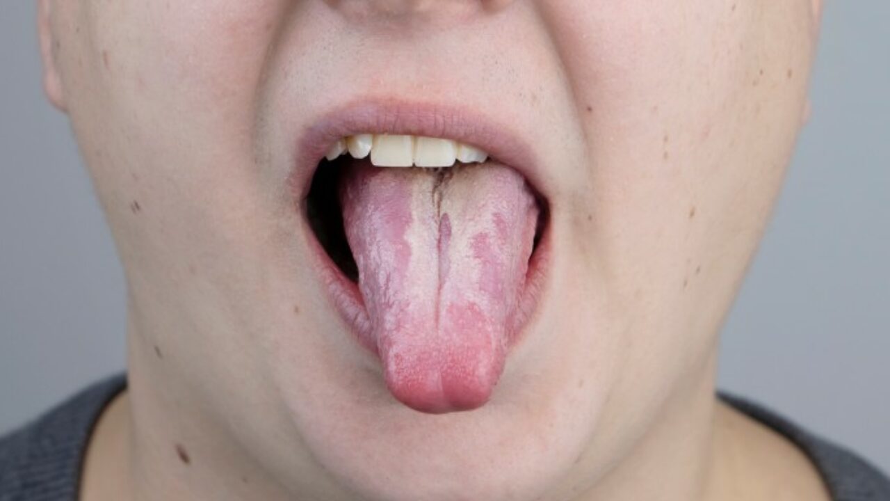Candidose Buccale Definition Duree Et Traitement