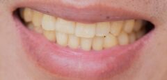 Dents jaunes, comment retrouver la blancheur ?