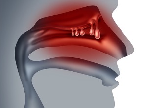 Symptômes des Polypes nasaux