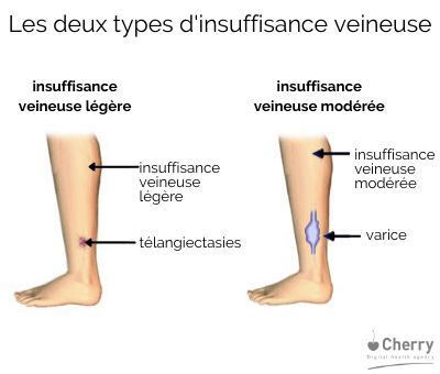 varice douloureuse que faire