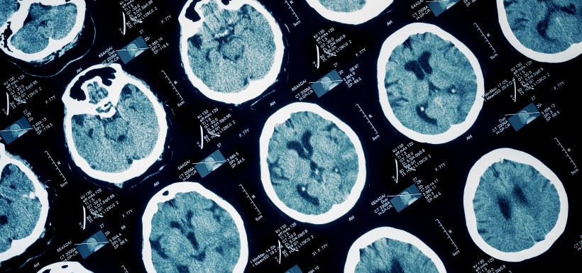 Covid-19 et cerveau : de potentielles lésions cérébrales