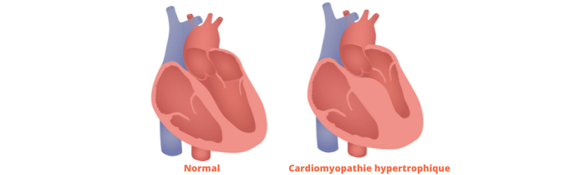 cardiomégalie, ou hypertrophie du cœur