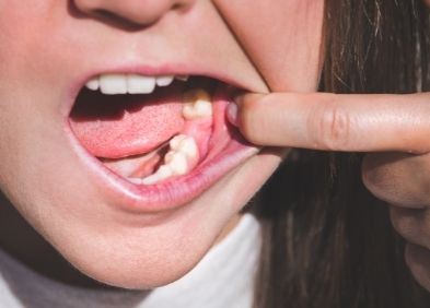 bucco dentaire aphtes caries abces mycose buccale gingivite