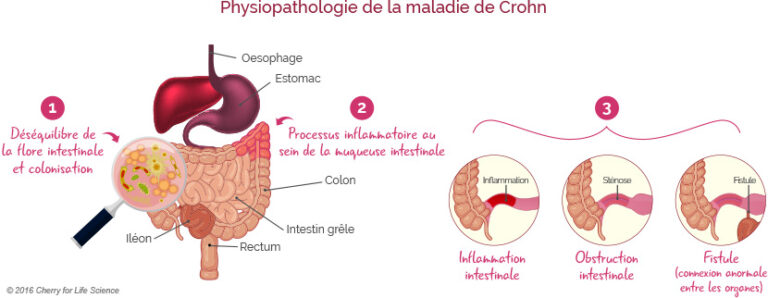 Maladie de Crohn : Définition et symptôme - Santé sur le Net