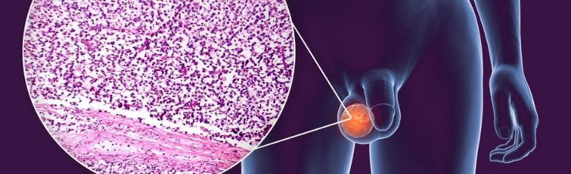 Cancer du testicule : symptômes, diagnostic, traitements