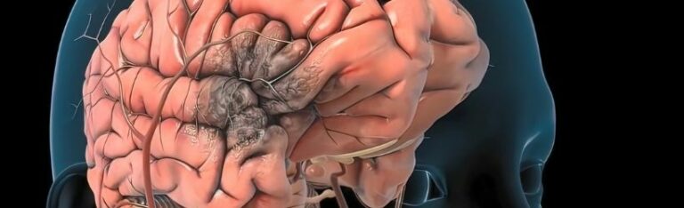 Rupture d’anévrisme : symptômes, diagnostic et traitement
