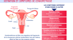Iinfographie-endométriose