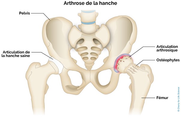 Arthrose : maladie chronique et affection dégénérative qui touche le  cartilage