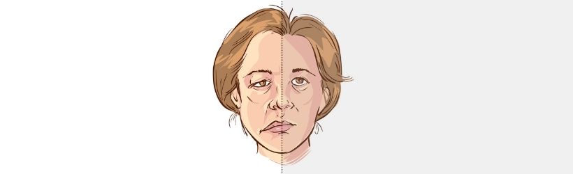 Paralysie faciale : définition, symptômes, traitement