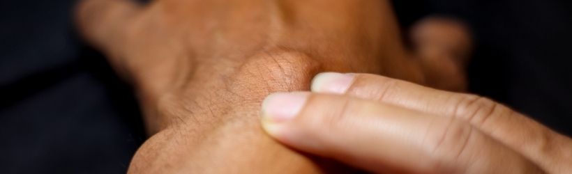 Lipome : comment savoir si une boule de graisse est cancéreuse ?