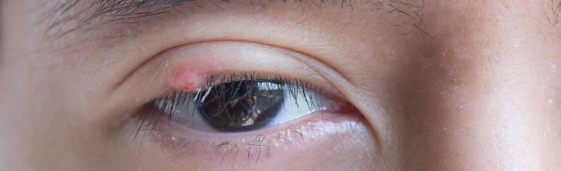 Chalazion : définition, symptômes, diagnostic et traitements