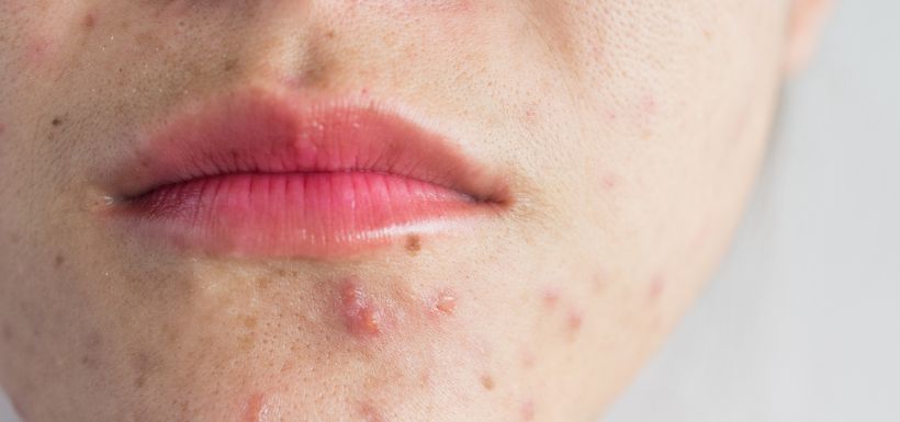 Bouton d'acné ou de fièvre : comment les différencier ?