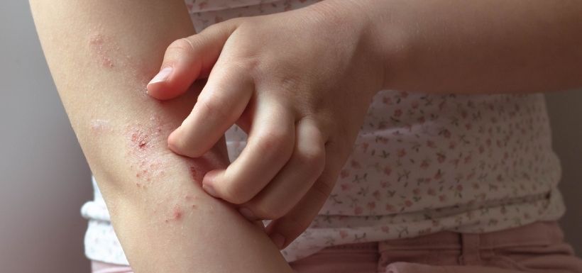 Journée nationale de l’eczéma : zoom sur son effet sur le sommeil Journée nationale de l’eczéma : zoom sur son effet sur le sommeil