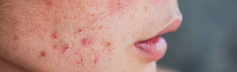 Boutons d'acné : causes et traitements