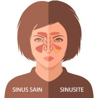 La sinusite peut causer un syndrome de choc toxique