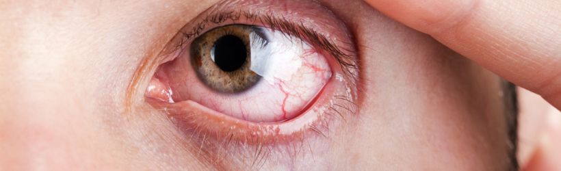 Yeux secs (sécheresse oculaire) : définition, symptômes, traitements -  Sciences et Avenir
